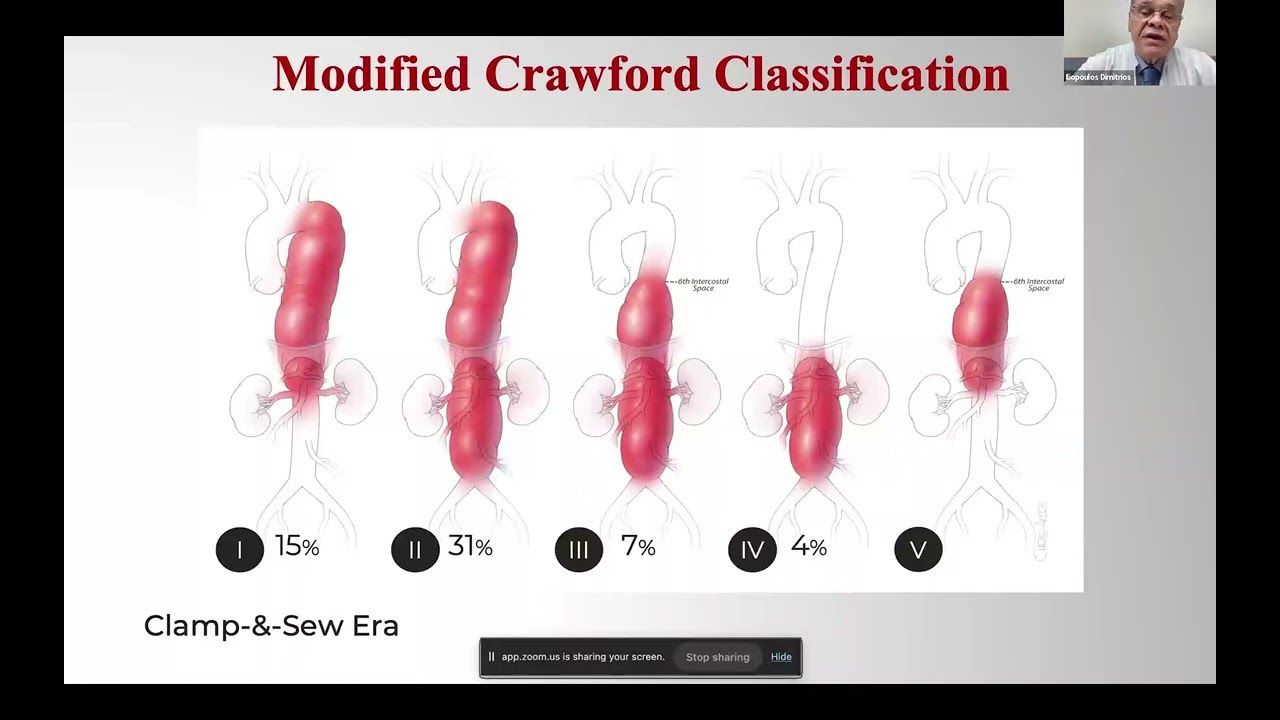 48o Μάθημα της Ακαδημίας Χειρουργικής Θώρακος Καρδιάς