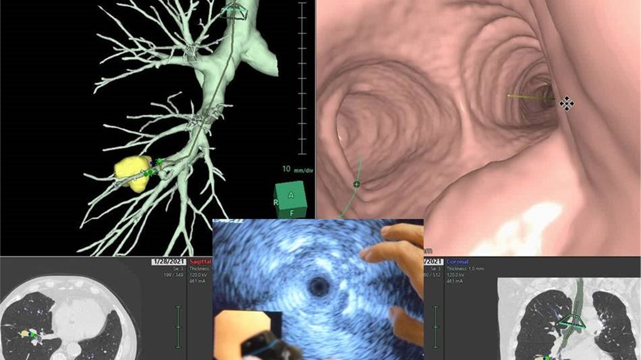 Bronchoscopy On Air #1: Peripheral Pulmonary Lesion / Rebiopsy