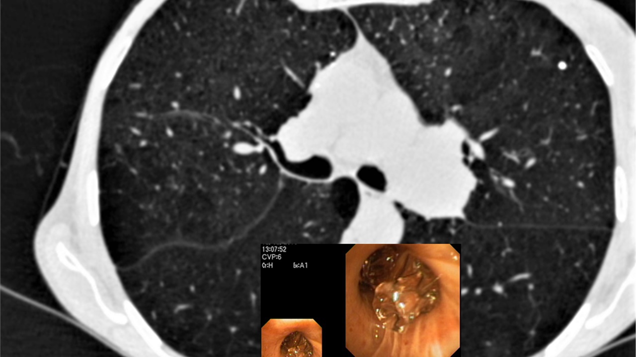 Bronchoscopy on air #2: Lung Volume Reduction for Severe Lung...