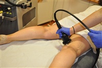 Smartlipo