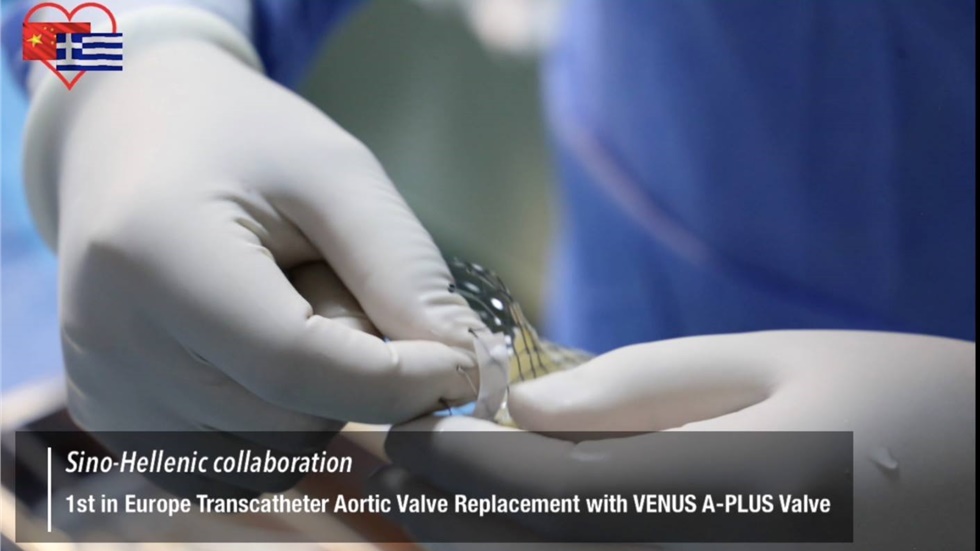 Transcatheter Aortic Valve Replacement with VENUS A PLUS Valve