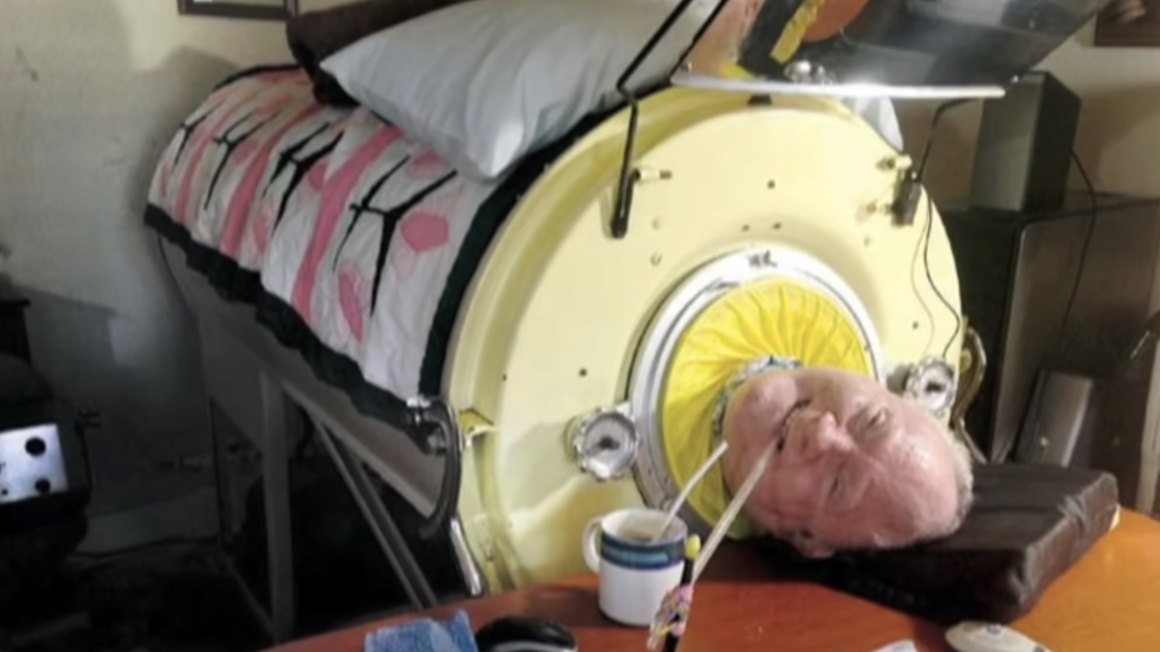 Ο Πολ Αλεξάντερ, ο άνθρωπος που έζησε 72 χρόνια μέσα σε ένα «σιδερένιο...